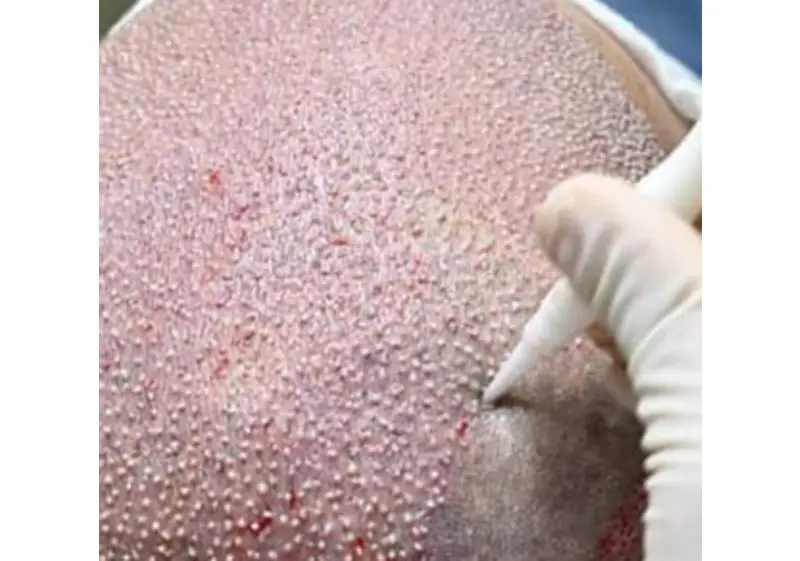 Hair Transplant In Istanbul