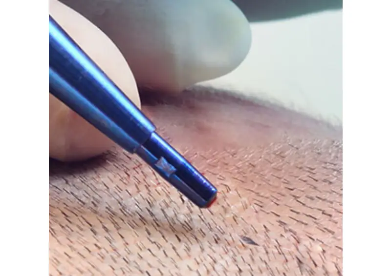 Hair Transplant In Istanbul