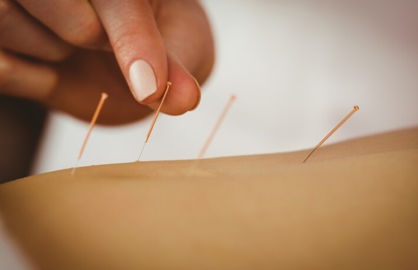 Acupuncture therapist