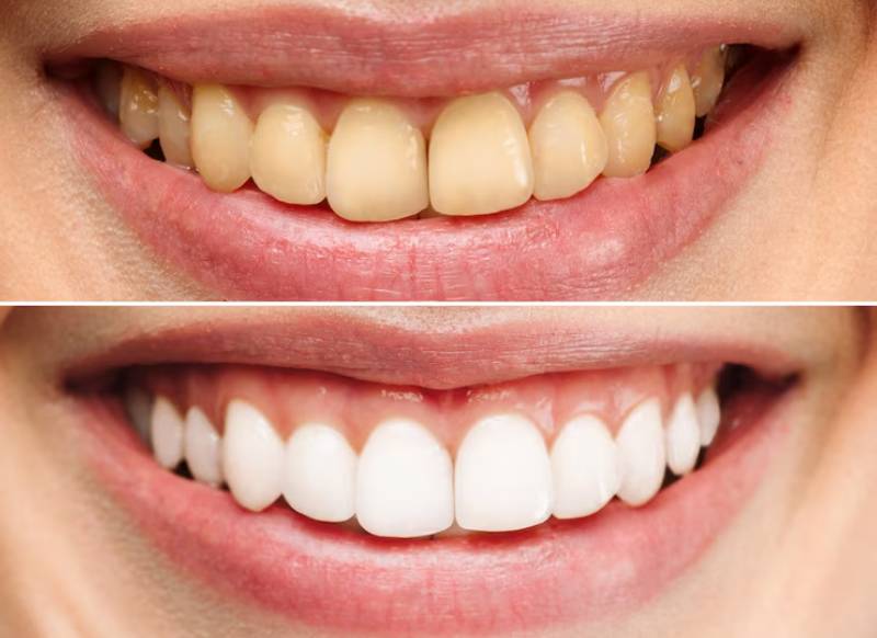 teeth whitening