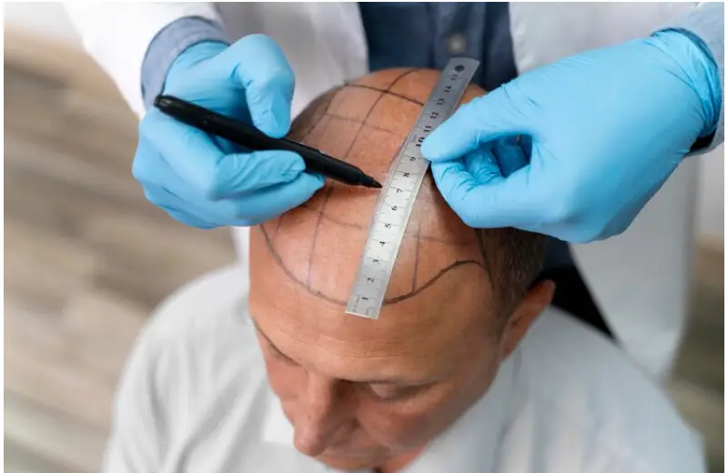 FUE hair transplant in Istanbul