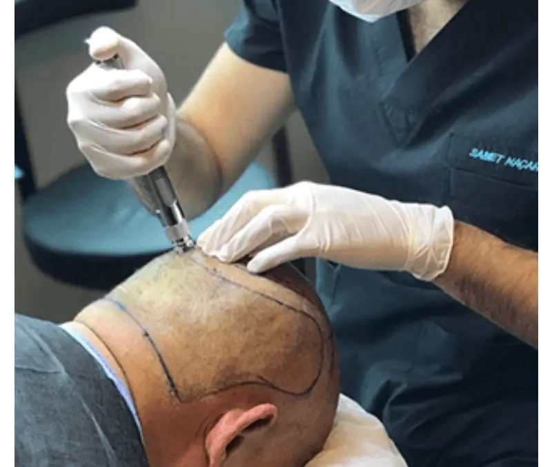 FUE hair transplant in Istanbul
