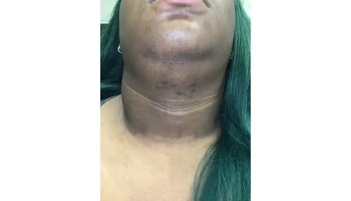 acne specialist