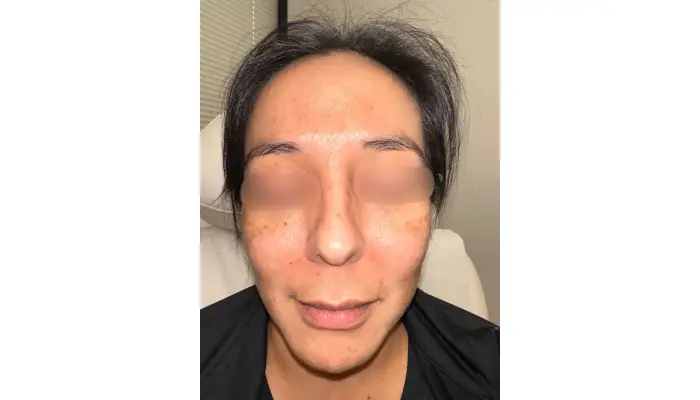 acne specialist